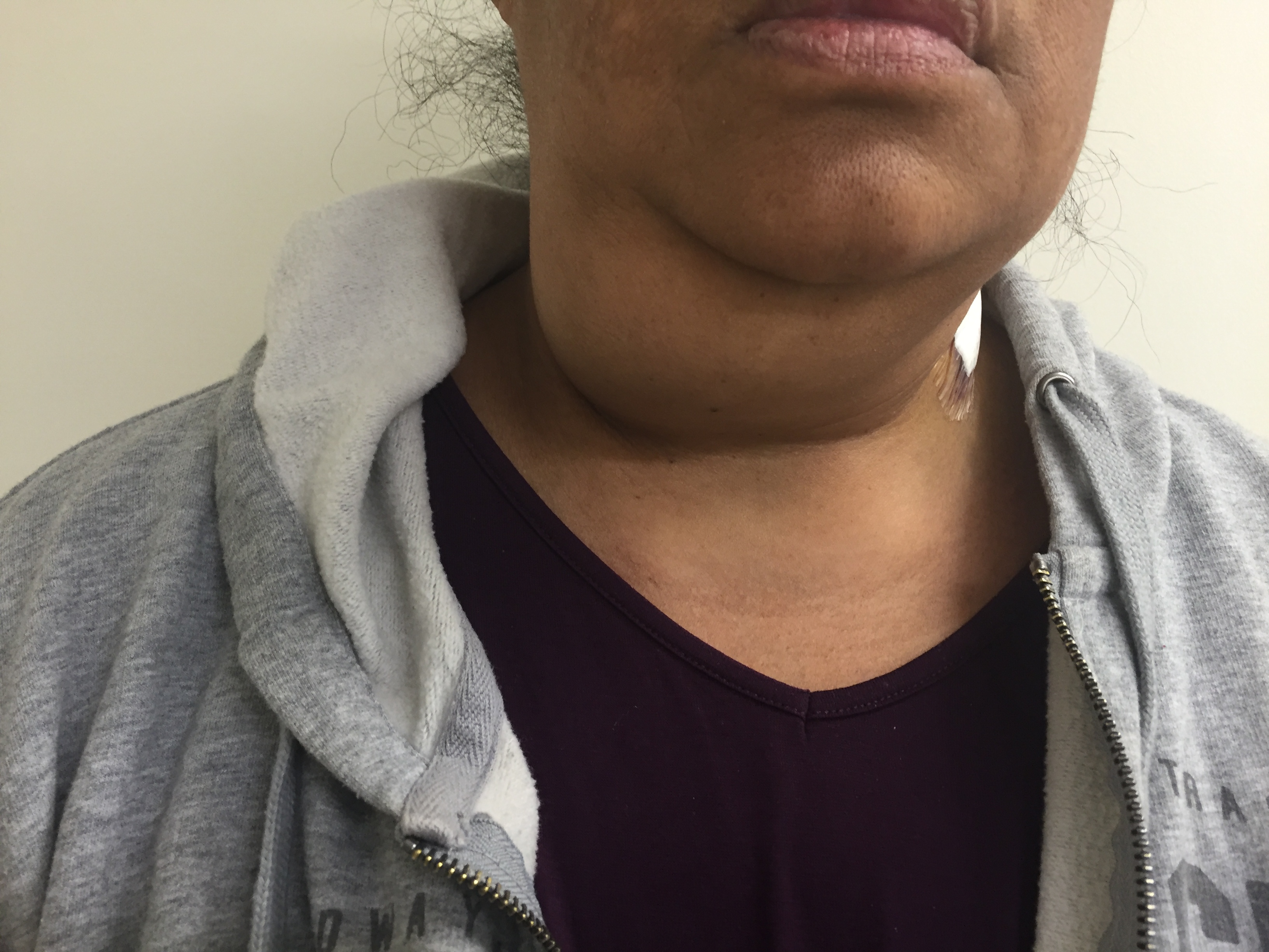 swelling in jaw and neck