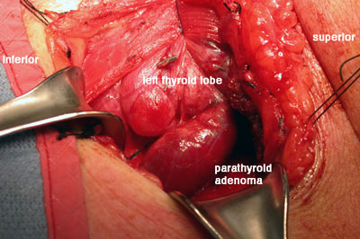 Parathyroid surgery