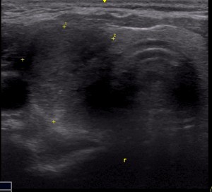 thyroid ultrasound showing right thyroid cancer
